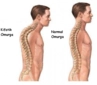 Boyun Eğriliği Belirtileri ve Tedavisi Boyun Eğriliği Belirtileri ve Tedavisi