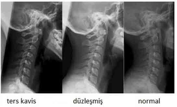 Boyun Kemiği Düzleşmesi Belirtileri ve Tedavisi Boyun Kemiği Düzleşmesi Belirtileri ve Tedavisi