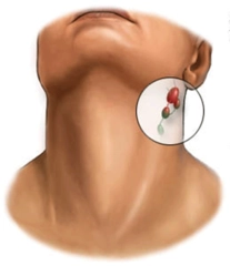 Boyunda Kitle Belirtileri ve Tedavisi Boyunda Kitle Belirtileri ve Tedavisi